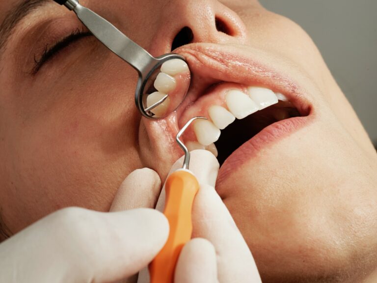 5 Vorteile einer professionellen Zahnreinigung